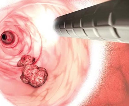 Phương pháp điều trị ung thư ống hậu môn